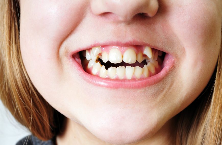 person with misaligned teeth